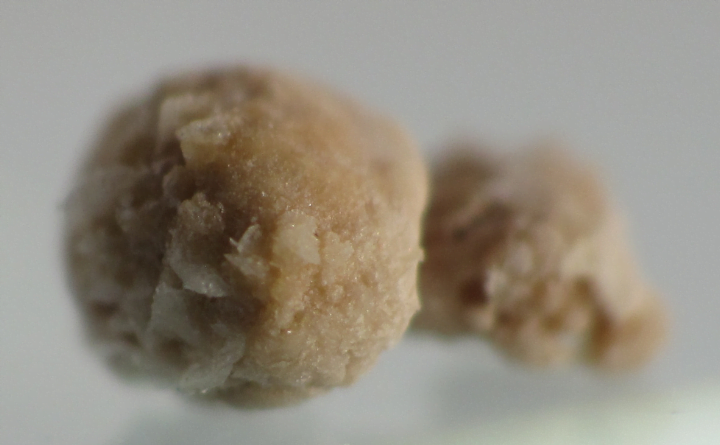 The Kidney Stone Formation