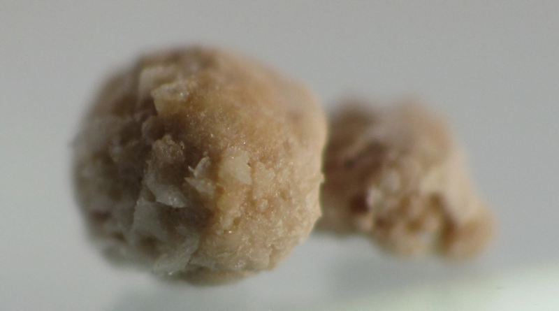 The Kidney Stone Formation