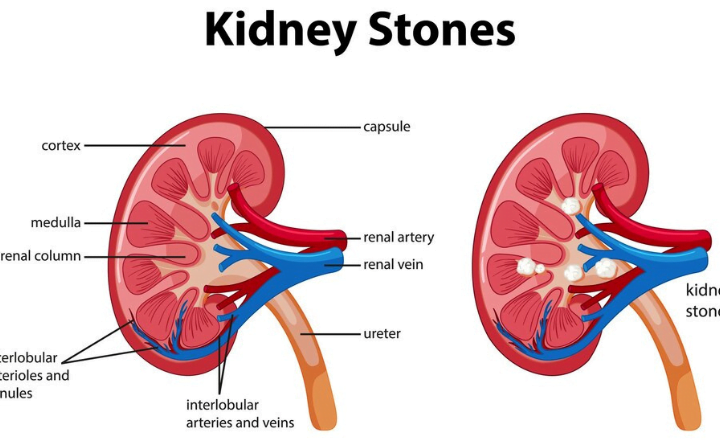 Are Kidney Stones Hereditary Understanding the Genetic Link