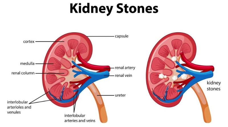 Are Kidney Stones Hereditary Understanding the Genetic Link