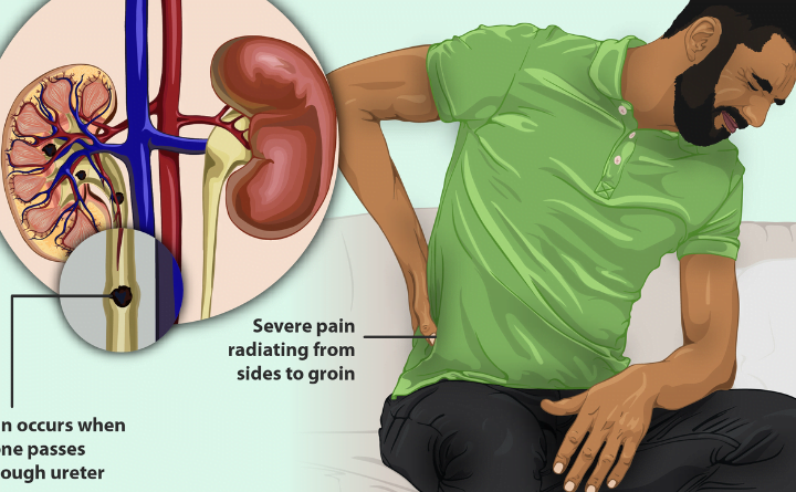 Delving into the Formation of Kidney Stones A Comprehensive Guide