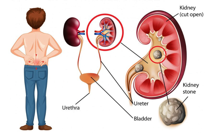 Navigating the Passage How to Pass a Kidney Stone in 24 Hours