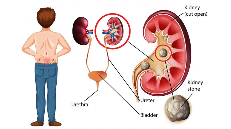 Navigating the Passage How to Pass a Kidney Stone in 24 Hours