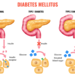 Understanding the 3 Types of Diabetes