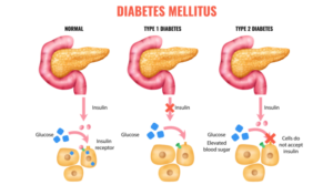 Understanding the 3 Types of Diabetes