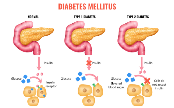 Understanding the 3 Types of Diabetes